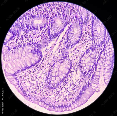 Ileum Histology Chronic Granulomatous Inflammation Histologically