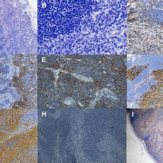 Pathological examination of the lymph node biopsy. (A and B). The lymph ...