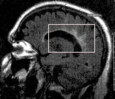 Multiple Sclerosis Mri Dawsons Fingers