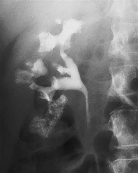 Intravenous Urography Technique And Interpretation Radiographics