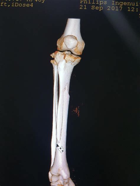 Tibial Plateau Fractures Trauma Orthobullets