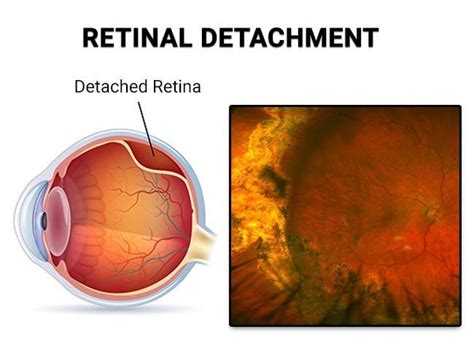 What Is Retinal Detachment Treatment By Dr Vaidya Eye Hospital Medium