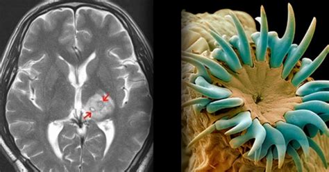 Cisticercosis cuáles son los síntomas de parásitos en el cerebro