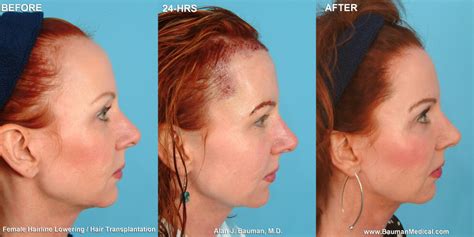 Before And Afters Archive Bauman Medical Group