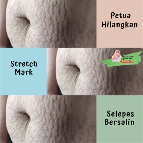 Cara Nak Hilangkan Stretch Mark Selepas Bersalin Kamryngroadkins