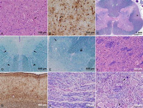 Microscopic findings in motor and sensory systems. (A, B) The primary ...