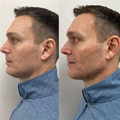 Cosmetic Procedures For Men Franklin Dermatology Group