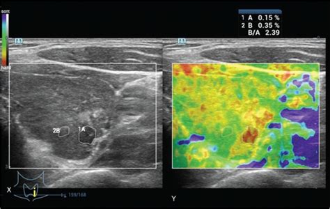 Scielo Brasil Use Of Strain Ultrasound Elastography Versus Fine