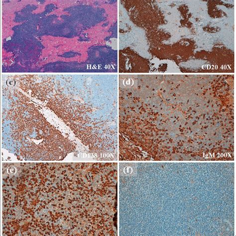 Histopathological Findings In Skin Lesion Biopsy Presence Of A