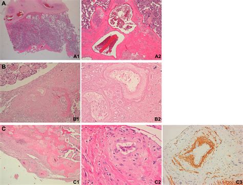 Spiral Arteries In The Placental Basal Plate A Normal Spiral Artery