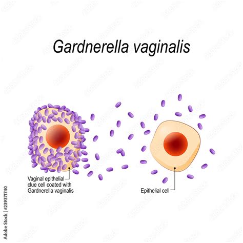 O Que É Gardnerella - Gardnerella vaginalis. Vaginal epithelial clue cell coated with ...