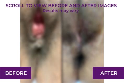 Perineoplasty Before And After Images And Videos Dr Michael Tahery