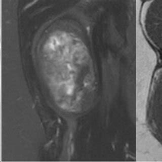 From left to right; front t1 and t2-weighted MRI sequences and axial t1 ...