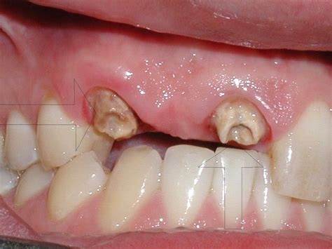 Badly Decayed Abcessed Teeth Pictures Tooth 6 Tooth 8 Dr Caputo Palm Harbor Dentist