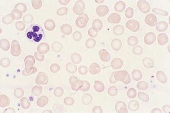 Pathology Iron Deficiency Anemia Kembara Xtra