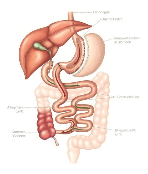 Bpd Ds Vs Sadi S For Bariatric Surgery Boehringer Labs