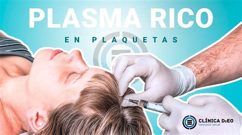 Plasma Rico En Plaquetas En El Tratamiento De La Alopecia YouTube