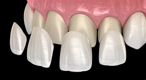 What Are Dental Veneers & How Do They Work?