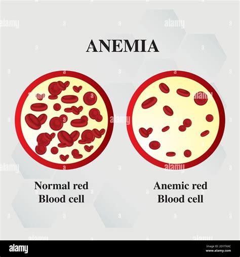 Anemia Sideropenica Immagini E Fotografie Stock Ad Alta Risoluzione Alamy