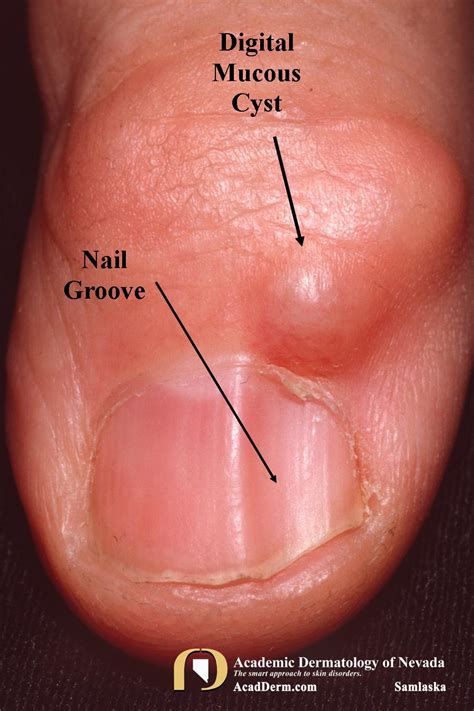 Digital Mucous Cyst Nail Bed My Bios