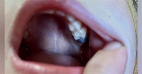 Eruption Cysts Symptoms And Recommendations For Pediatric Dental Patients Dentistry Iq