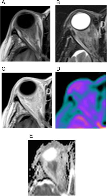 Arterial Spin Labeling And Diffusion Weighted MR Imaging Utility In