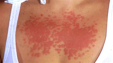 Poison Ivy Sun Poisoning Heat Rash A Guide To Summer Rashes