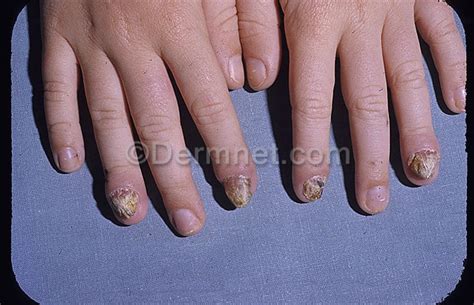 Chronic Mucocutaneous Candidiasis Medical Information