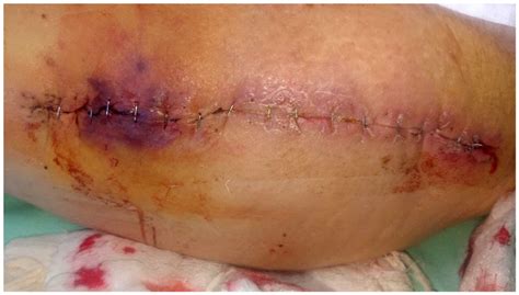 The Draining Surgical Wound Post Total Hip And Knee Arthroplasty What