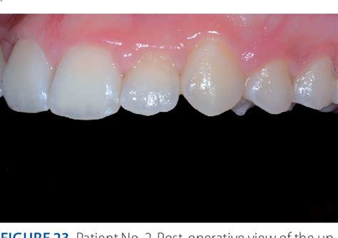 Figure 23 From Treatment Of Post Orthodontic White Spot Lesions By