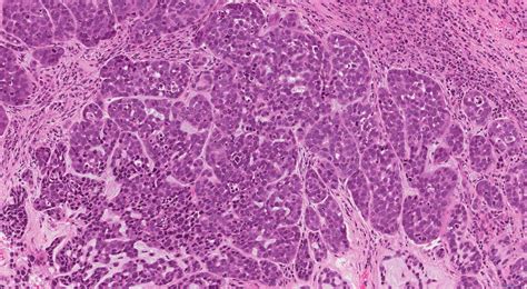 Basaloid Squamous Cell Carcinoma Of The Larynx Ottawa Atlas Of Pathology