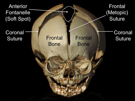 Isolated Craniosynostosis — Dallas Pediatric Plastic Surgeon