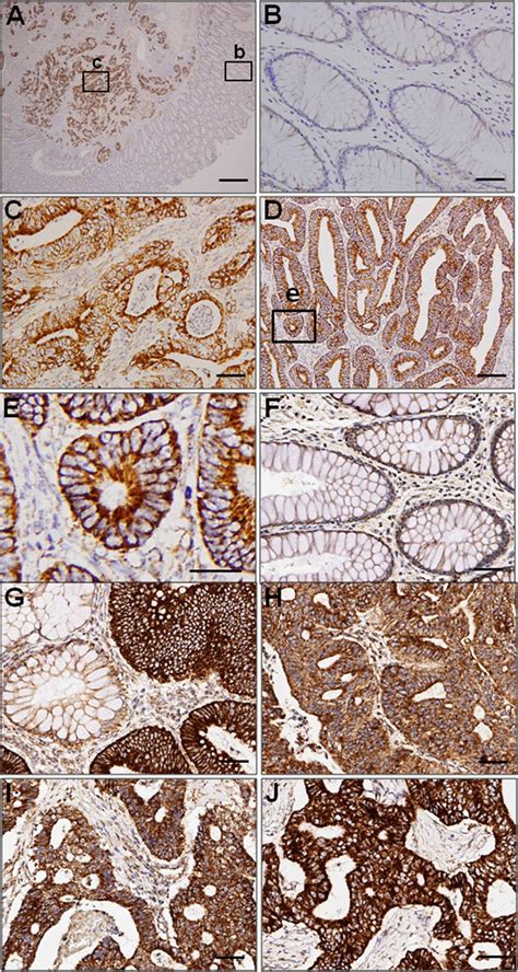 Ihc Analysis Of Stoml Expression In Crc Tissues Representative Ihc