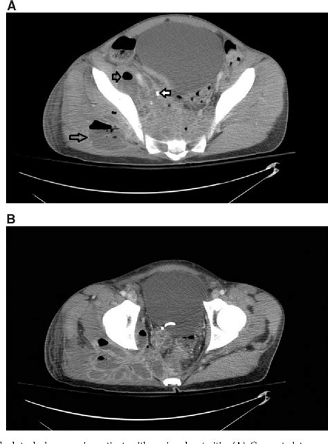 Figure 1 From Iliopsoas And Gluteal Abscesses In A Patient With