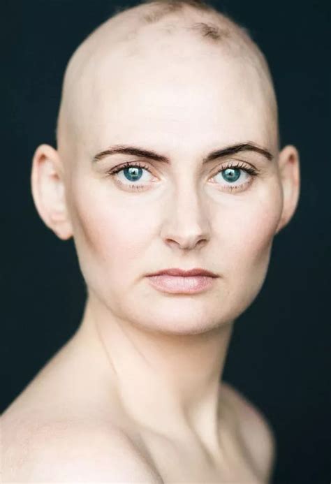 Bald is beautiful: Stunning images of women with alopecia challenge ...