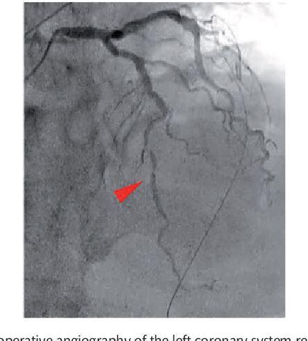 Figure 1 From Hybrid Treatment Combining Robotic Coronary Artery Bypass