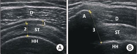 Figure 2 From Comparison Of Ultrasound Guided Subacromial