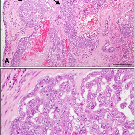 Snp Mammary Gland Tumor From Subcutaneous Tumor Tissue Nodcb17 Prkdc