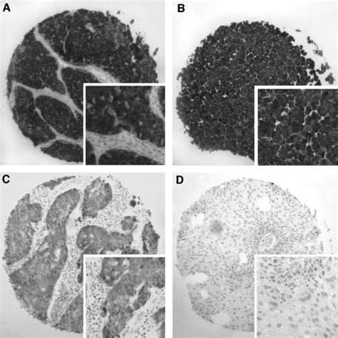 P16 Expression In Oropharyngeal Squamous Cell Carcinoma And Hela Cell Download Scientific