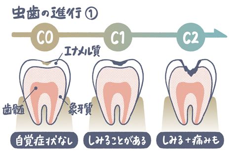 放置した虫歯は最終的にどうなる？虫歯が原因でほかの病気になることも【オトナのための歯科相談室3】 Kufura（クフラ）小学館公式