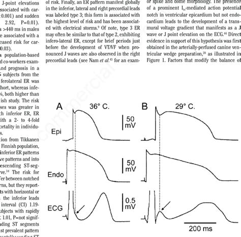 Hypothermia Induced J Wave Each Panel Shows Transmembrane Action