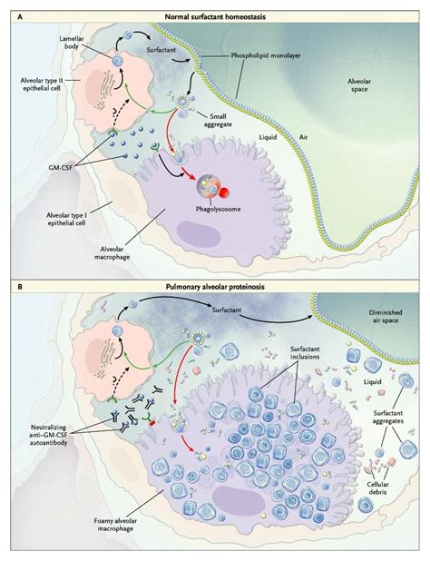 Pulmonary Alveolar Proteinosis Nejm