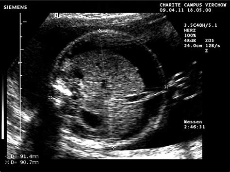 Figure From Etiology And Prognosis Of Fetal Ascites Semantic Scholar