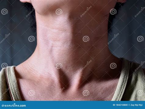 Smooth Diffuse Thyroid Swelling Of Southeast Asian Burmese Young Man