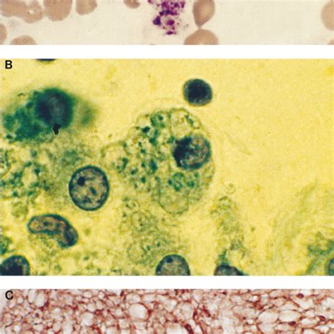 Survival Of Hiv Infected Patients With Extrapulmonary Pneumocystosis Download Scientific