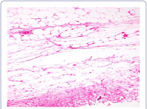 Histology Confirming Lipoma Consisting Of Multiple Fragments Of Mature