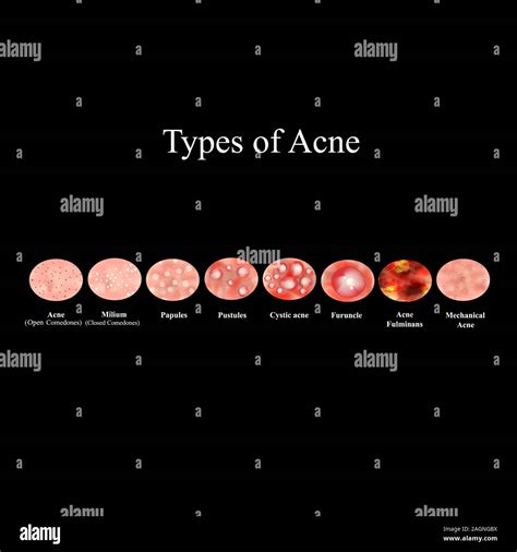 Types Of Acne Skin Inflammation Pimples Boils Whitehead Closed