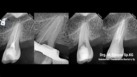 Broken File In Root Canal Treatment Remove Broken File In Root Canal N