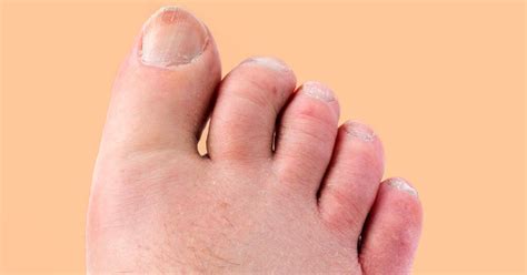 Psoriatic Arthritis In Your Toes Pictures Symptoms And Treatment