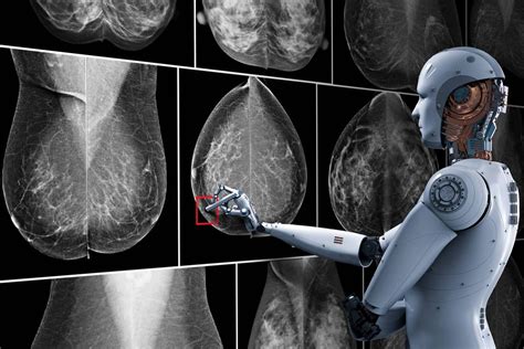 Ai Helps Speed Up Breast Cancer Tracking